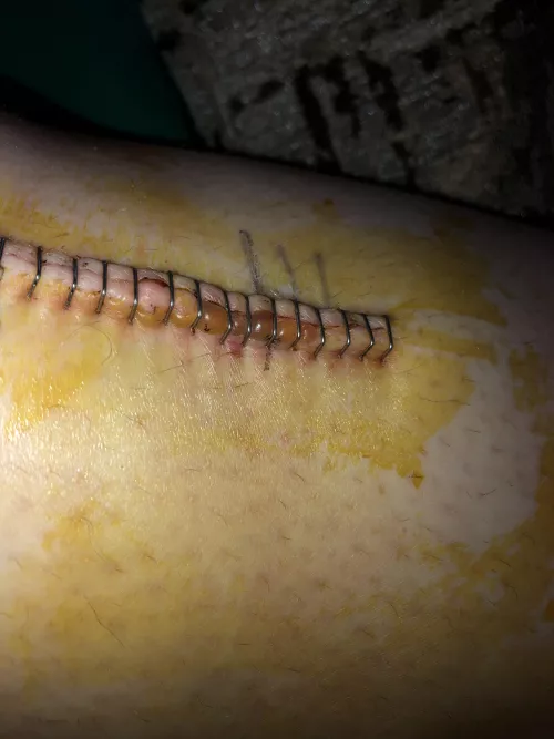 Forbidden pop of the fluid under my skin between the surgical staples on an incision.