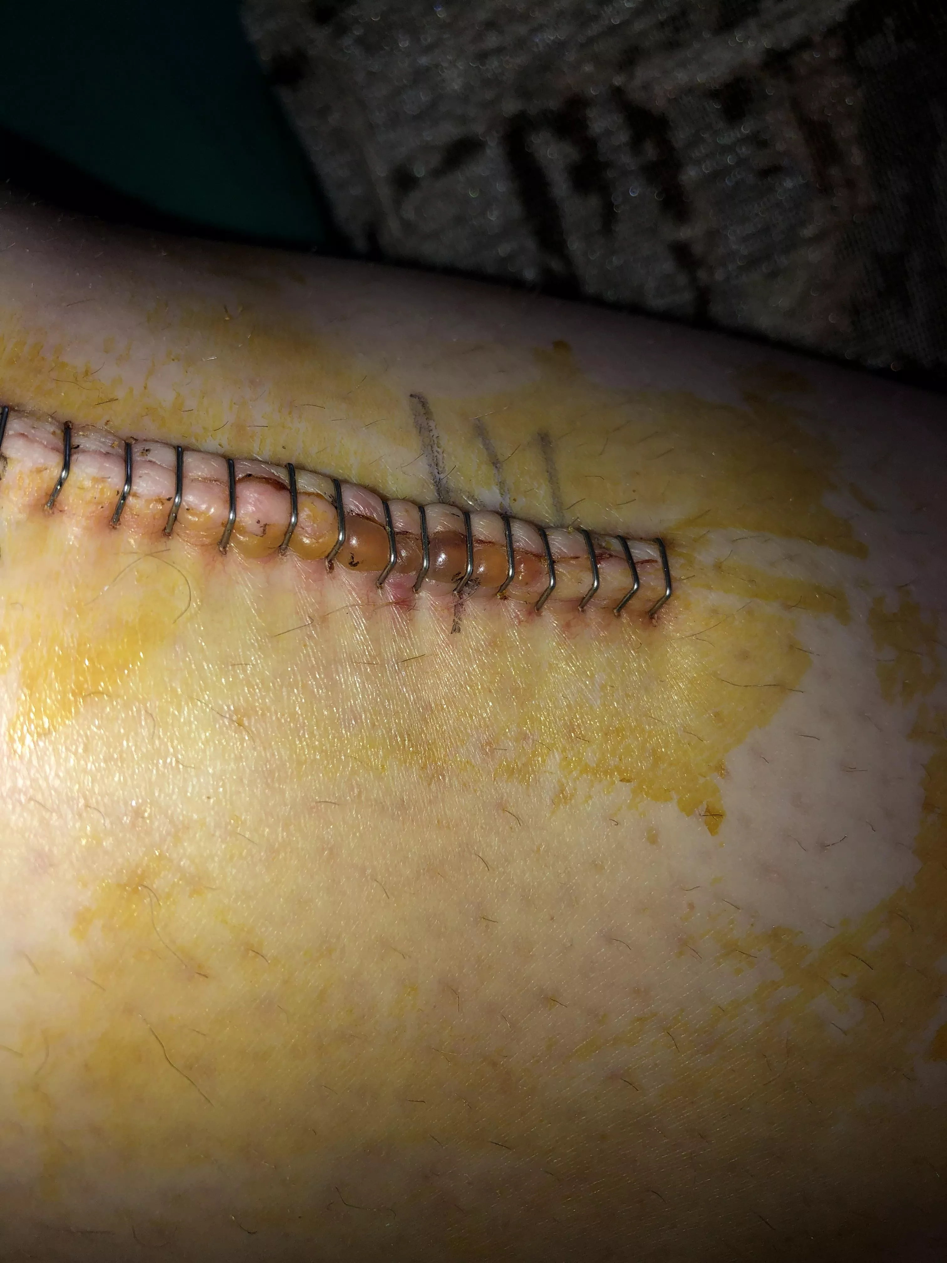 Forbidden pop of the fluid under my skin between the surgical staples on an incision.