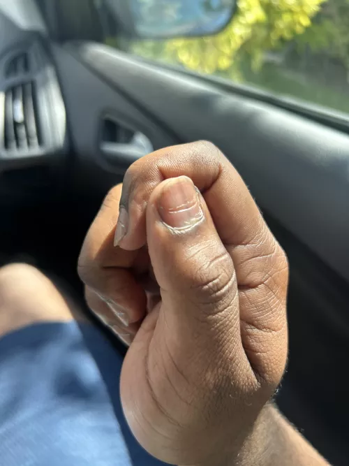 Any idea why my nails look like this? It’s all 10 fingers