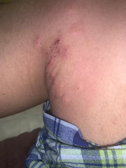 Does anyone know what is happening to my leg, whenever I pull my pants down to cover it, it itches and I keep changing my pants and it keeps itching and keeps getting worse. Any information what this is?