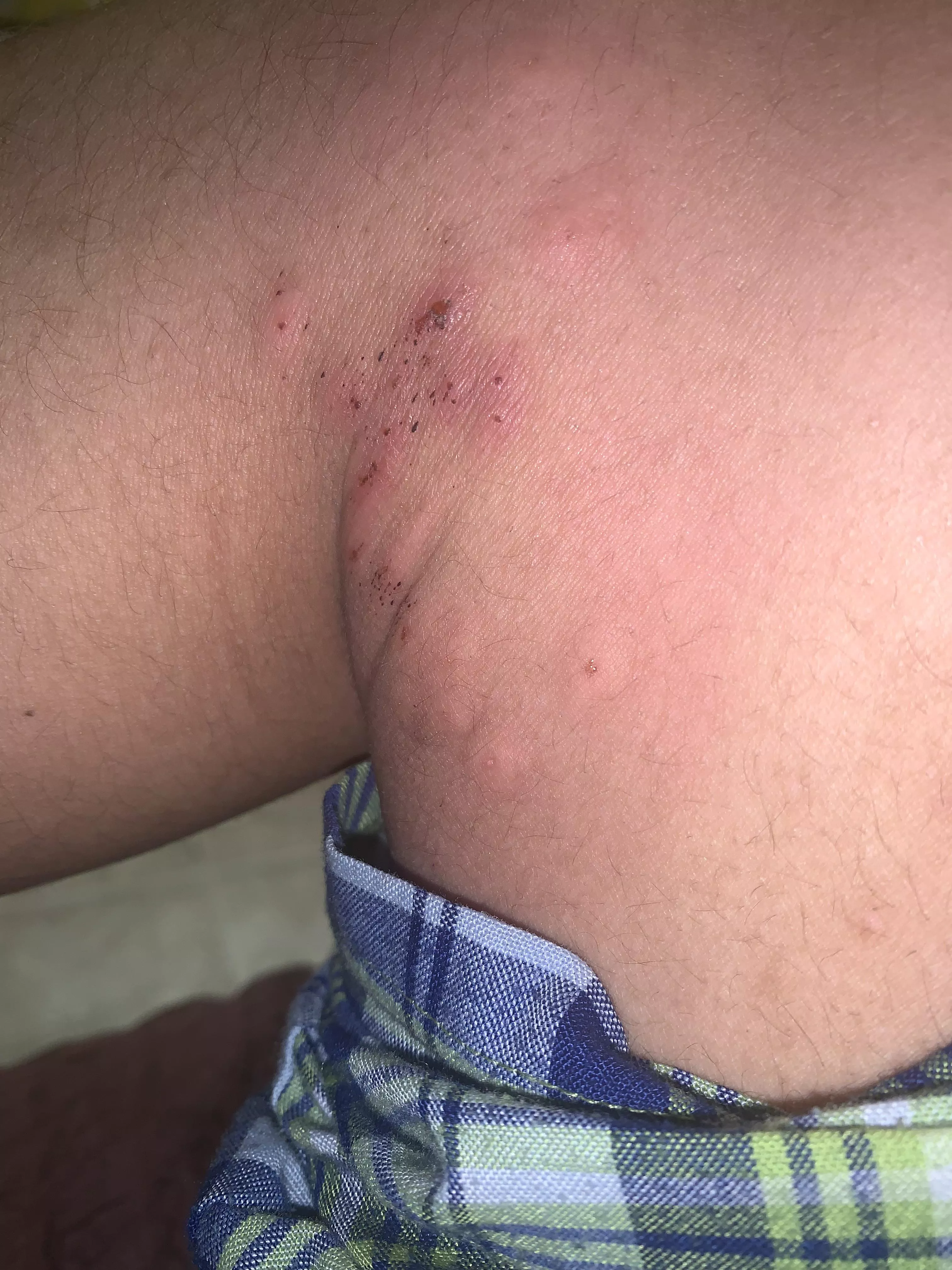 Does anyone know what is happening to my leg, whenever I pull my pants down to cover it, it itches and I keep changing my pants and it keeps itching and keeps getting worse. Any information what this is?
