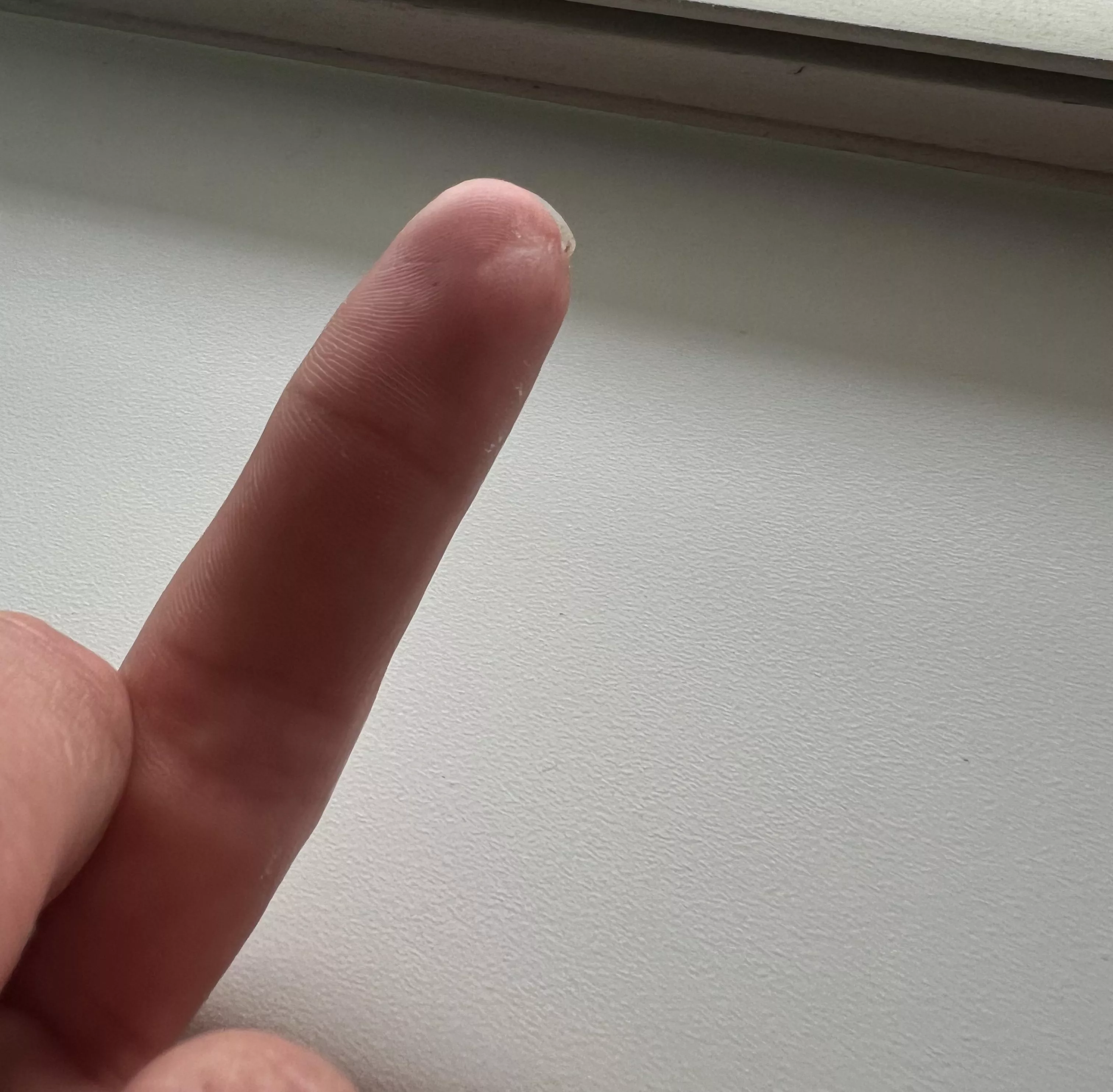 Fingertip scar 
