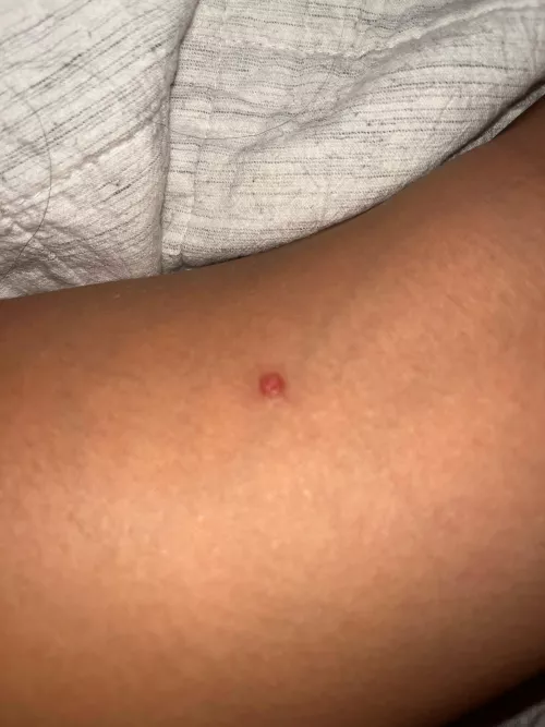 my friend wants to know what this is on her leg 
