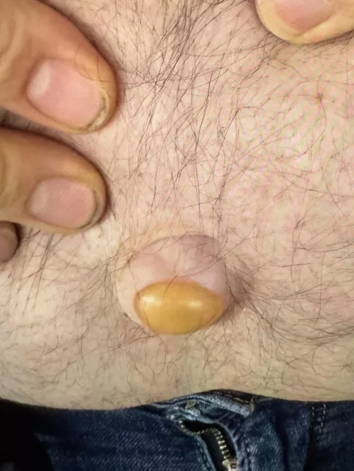 Weird bump on belly button