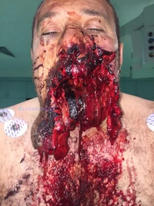 Facial trauma due to a suicide attempt with a gunshot
