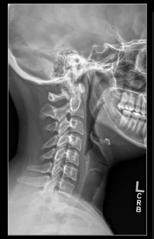 How long did your neck sprain or strain take to heal? 