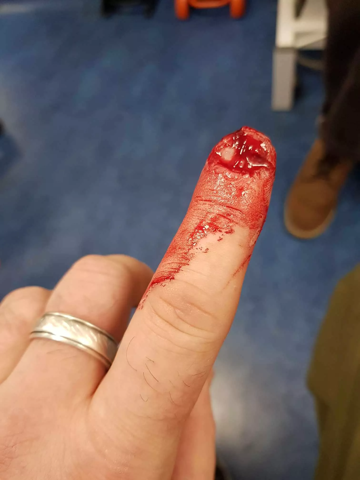 My fren had a mishap 