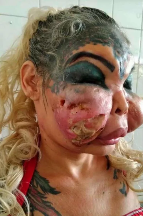 botched facial surgery