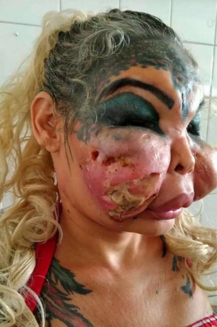 botched facial surgery