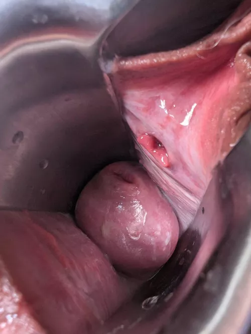 Speculum Makes My Cervix Bulge