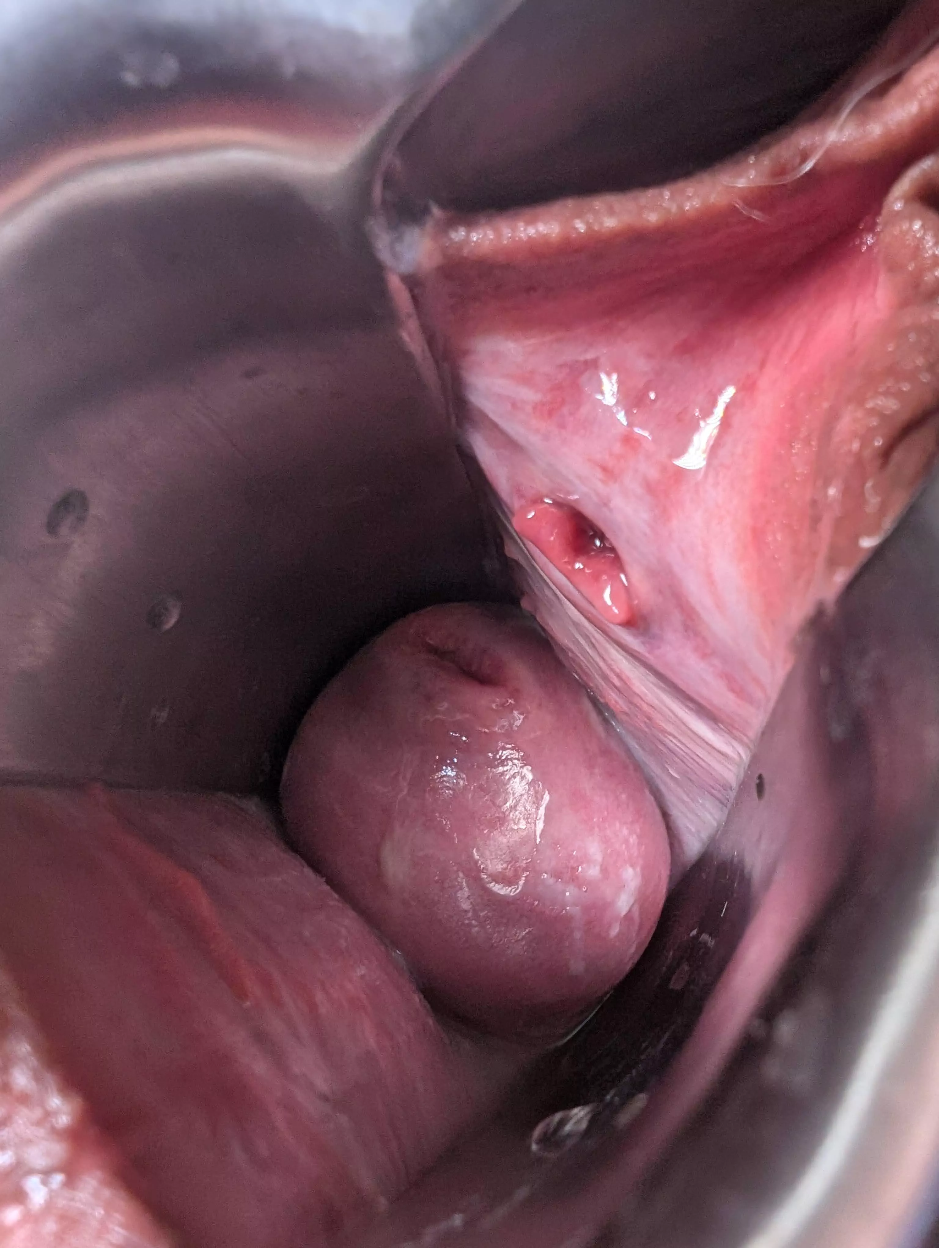 Speculum Makes My Cervix Bulge