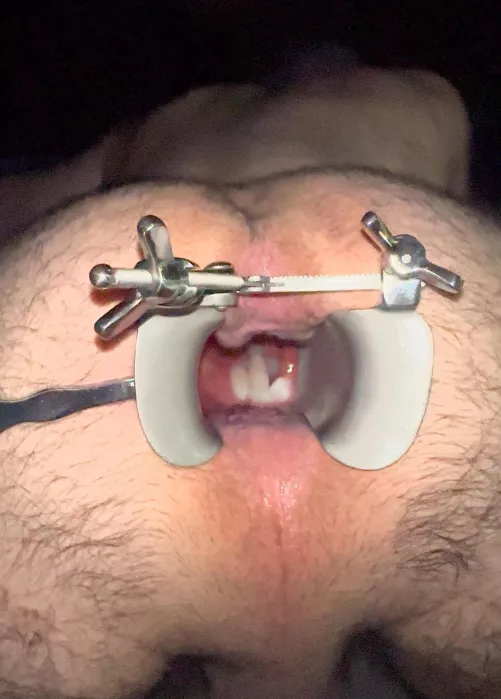 Trelat Speculum frozen cum