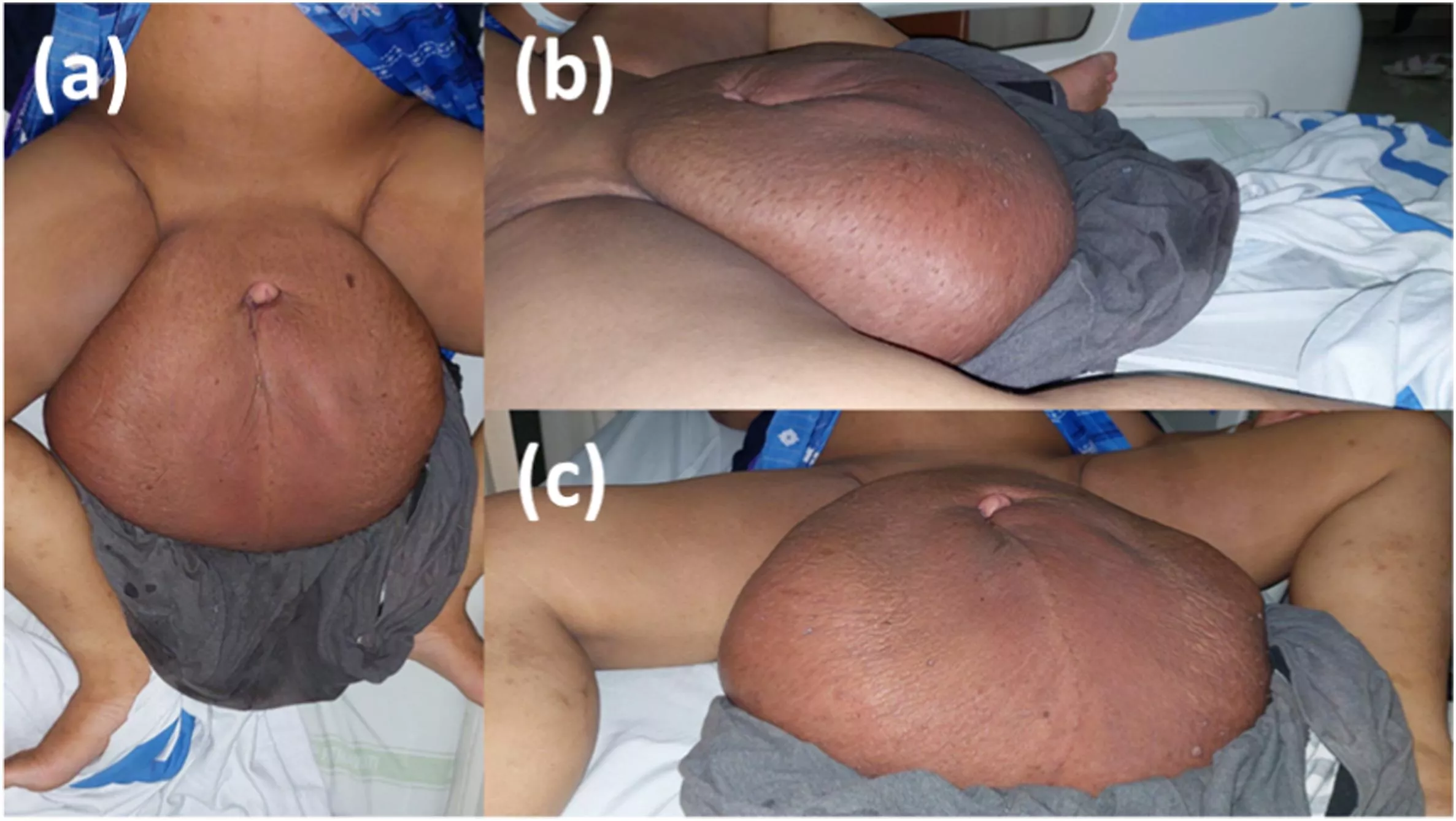 A man injected paraffin into his scrotum to make it bigger. The result was a massive lymphedema of the scrotum. He had to get a scrotoplasty with a 53x42×26 cm, 13 kilogram lump of flesh removed. It was the largest scrotal enlargement we ever recorded d