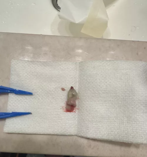 Anybody know what I pulled out infected spot on arm?