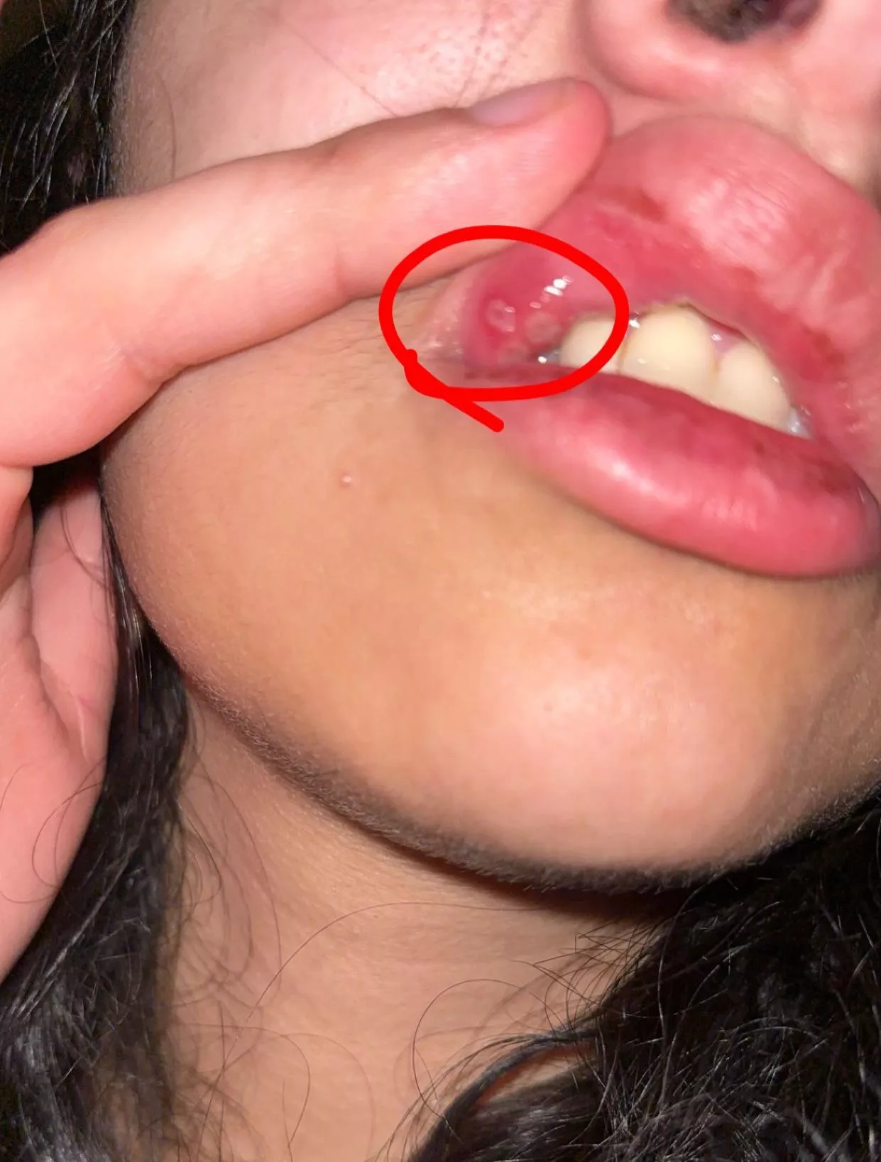 My biannual canker sores all in one spot