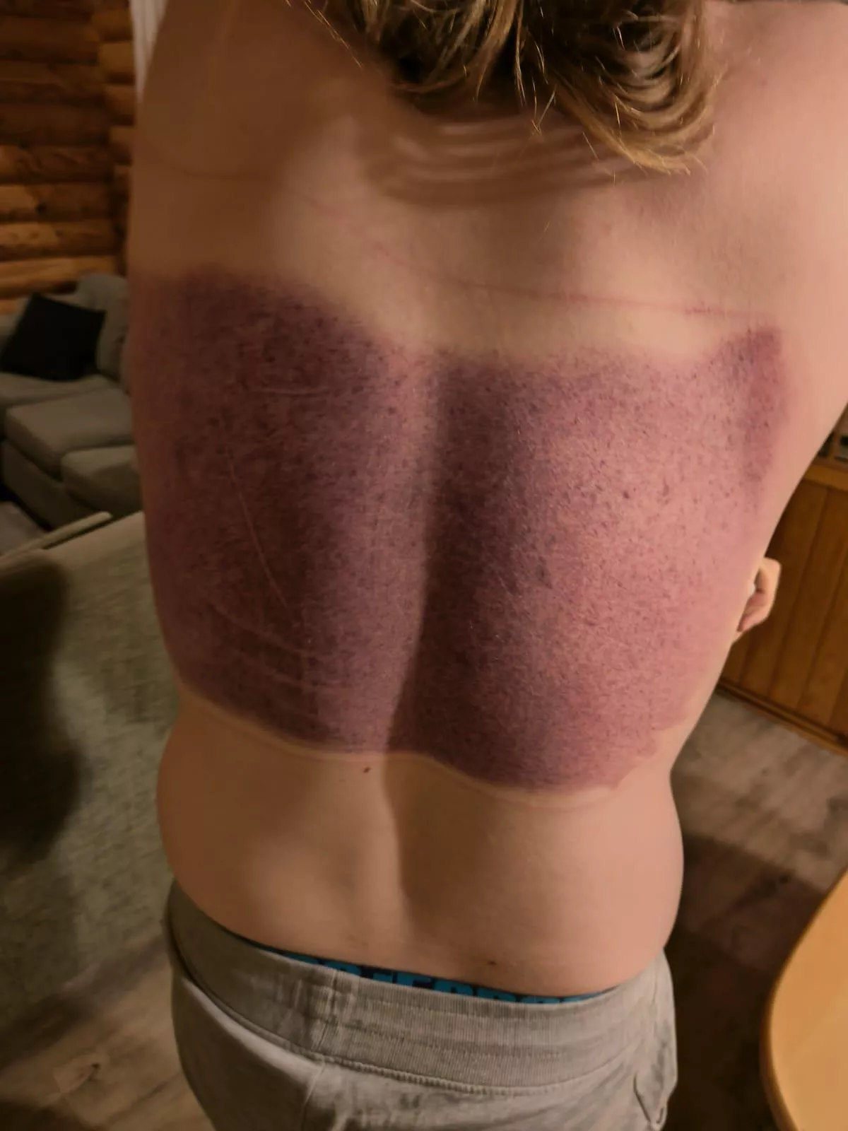 My bruised back after getting sucked into a hot tub drain.