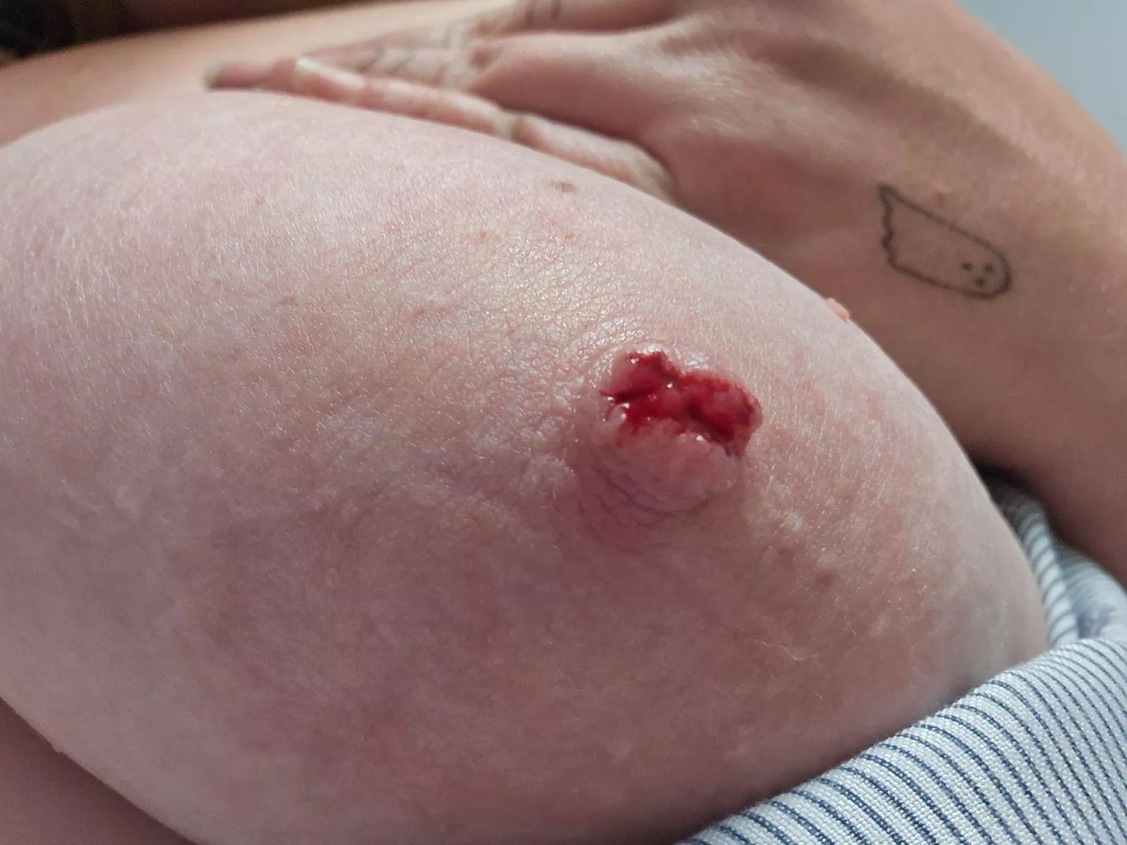 My piercing got caught today and completely ripped out of my nipple 🥲