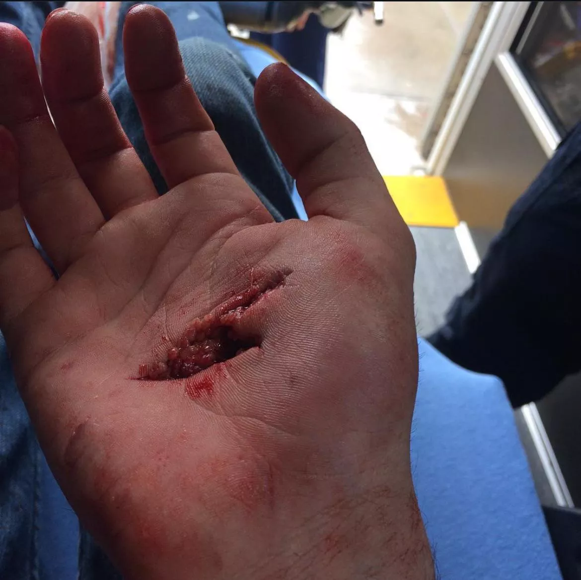 Sliced my hand open on a Starbucks bottle. 