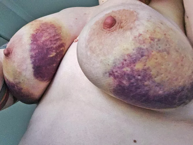 Day 3 after a fun impact session 