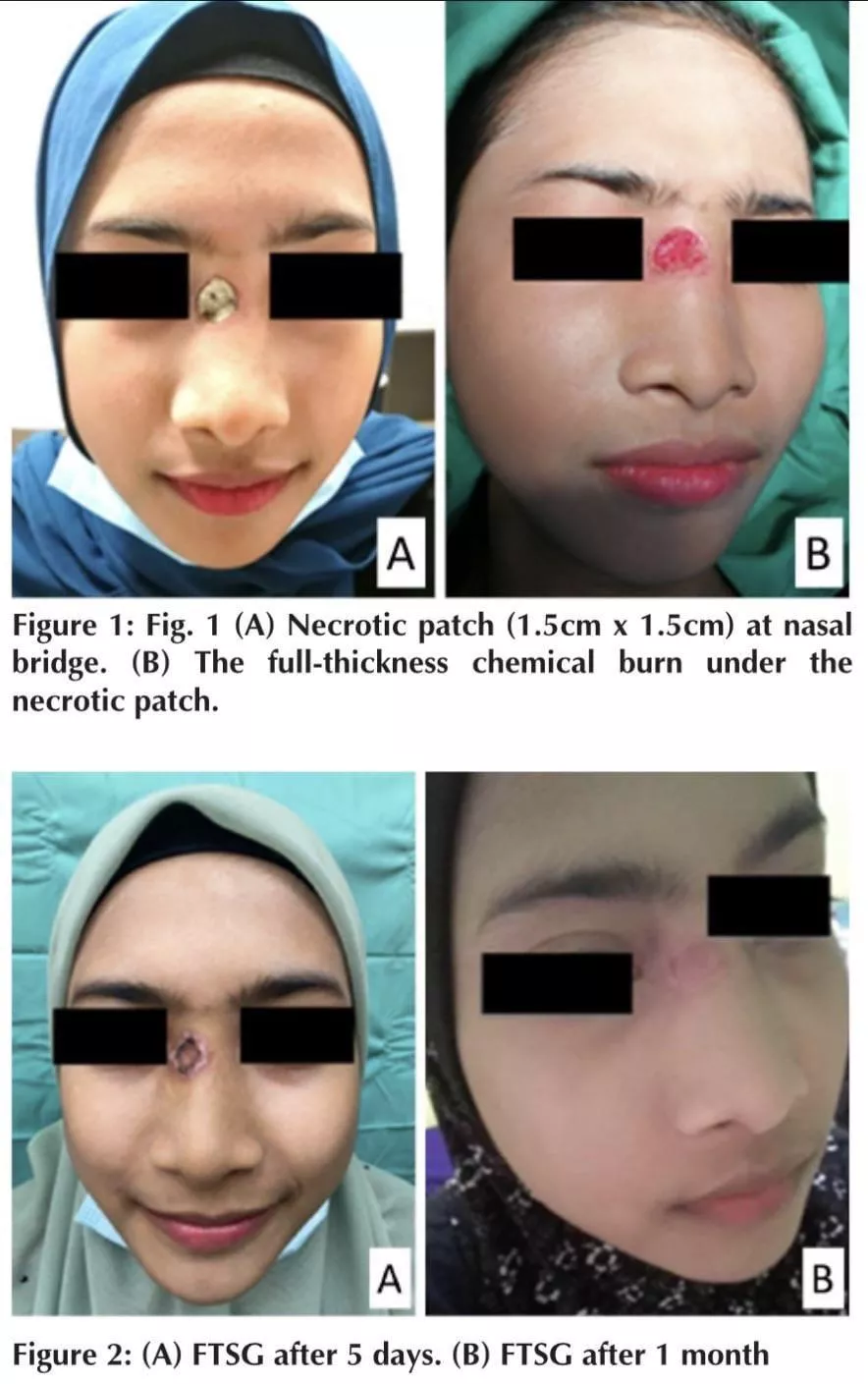 A woman attempted mole removal with an “unauthorized” cream made of cinnamon, lemon juice and vitamin E. Result: chemical burn and necrosis. The necrotic patch got bigger than the original mole had been and she needed surgery and a skin graft.
