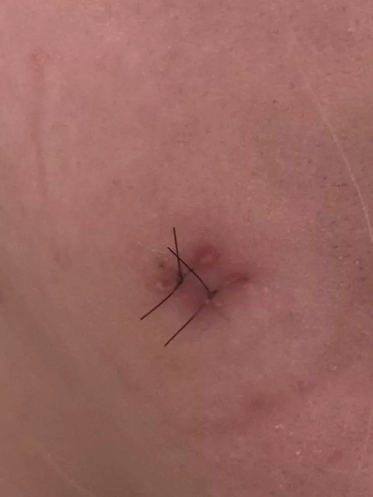 Do my stitches look infected? 
