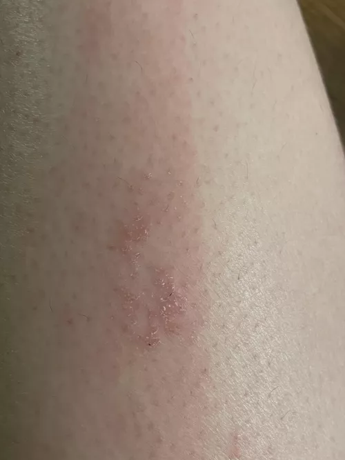 Eczema? 