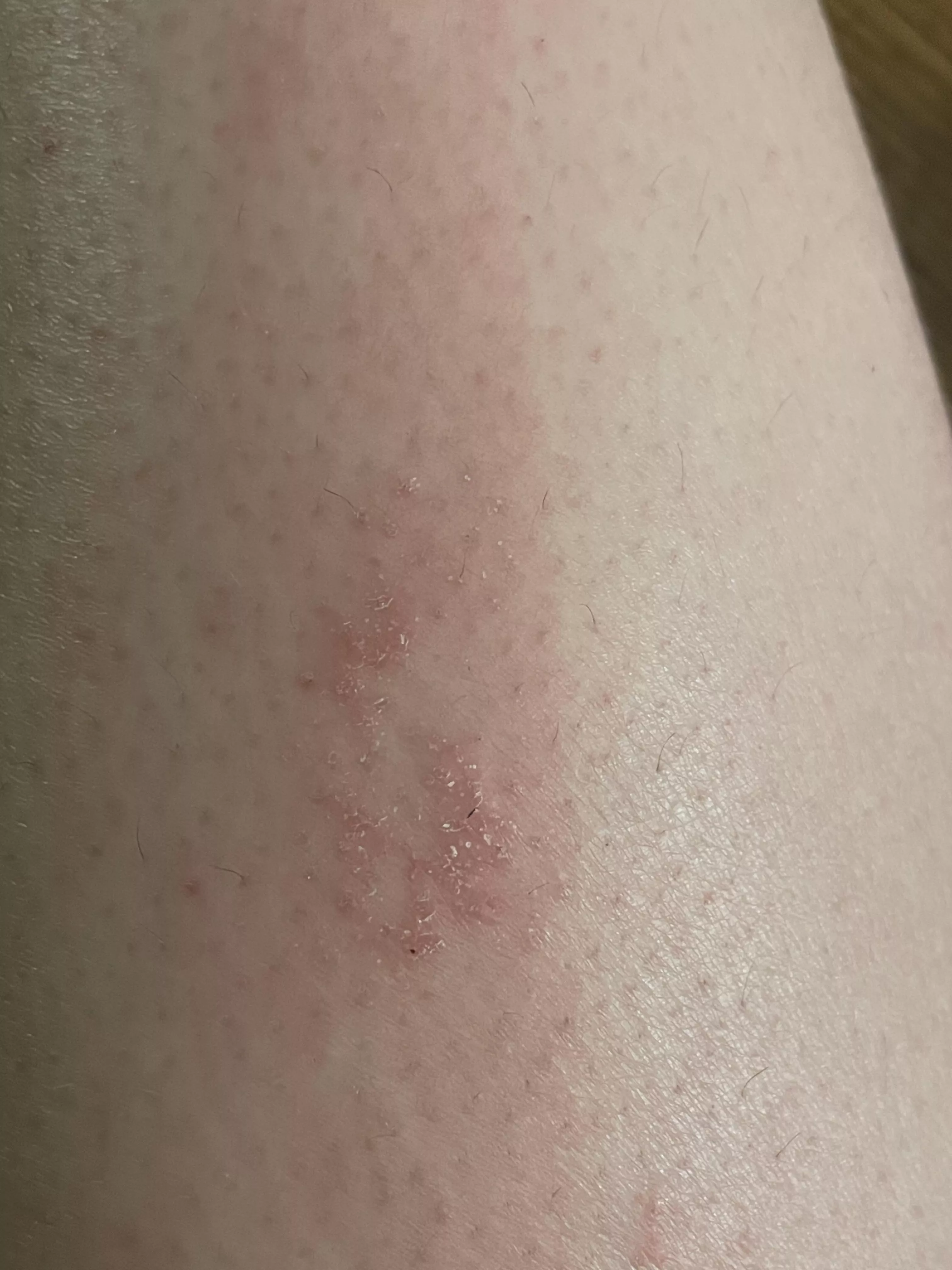 Eczema? 
