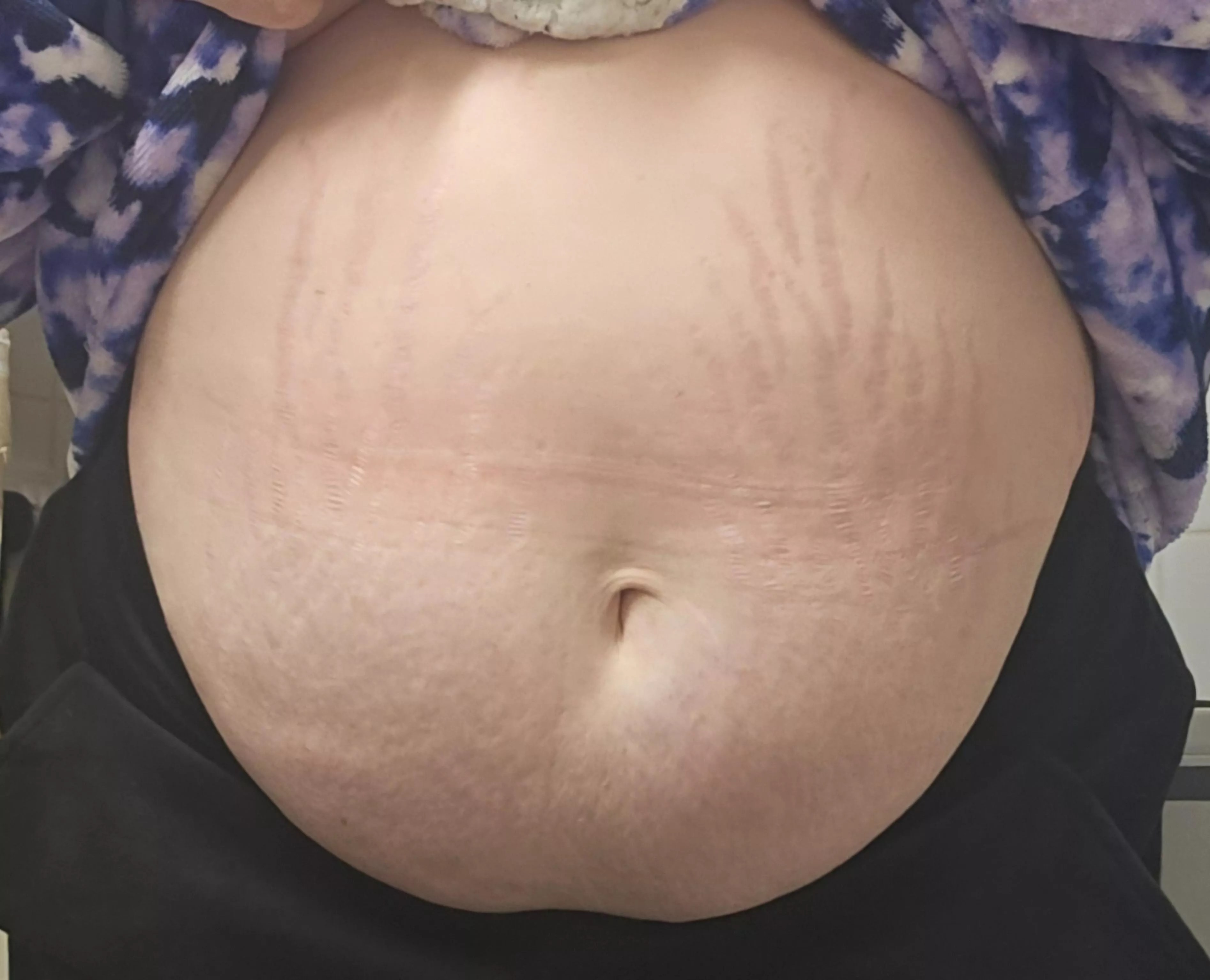 My stretch marks are so noticeable now ! 