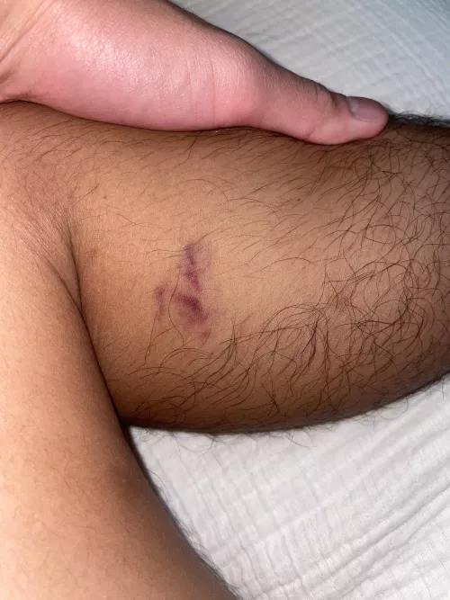 purple bruise on left calf, no obvious reason 
