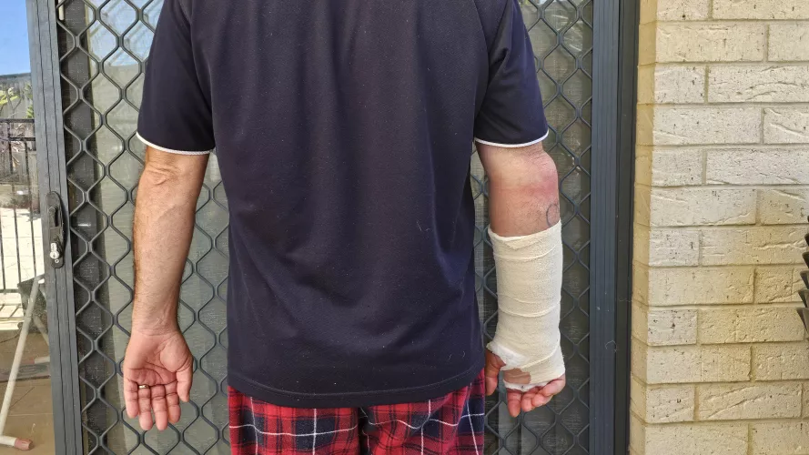 Severe swelling above bandage after surgery for broken wrist