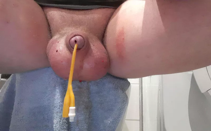 500 ml and 12 ch katheter