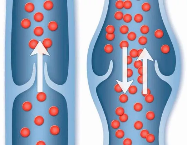 If we enlarge the veins, wouldn't blood escape from the penis faster?