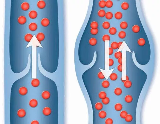 If we enlarge the veins, wouldn't blood escape from the penis faster?