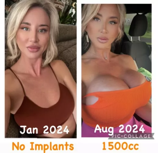 No implants in January, 1500cc by August