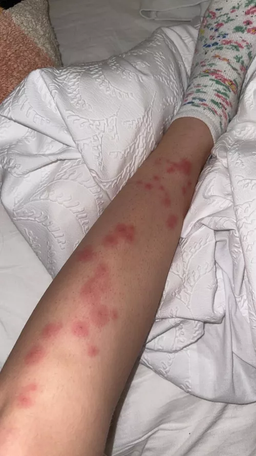 Waxed my legs and only on one leg did these really sore pus filled bumps show up. what are they! and how do i get rid of them!! please help 