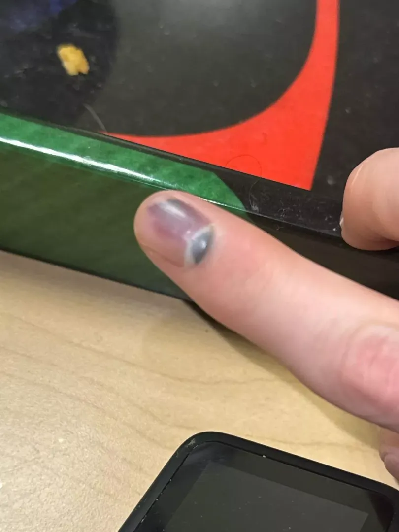 Is my finger nail dead? Smashed it in a car door 3 days ago. 