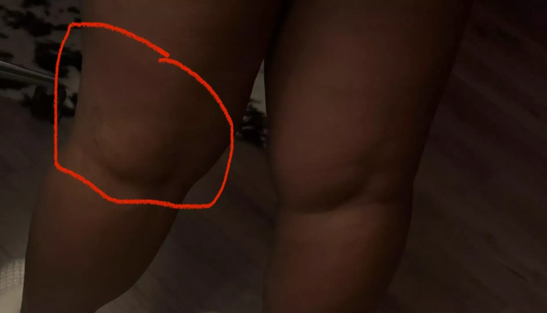 Lump behind knee with spider veins 