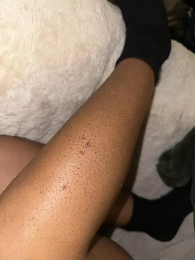 warts? i have these bumps on my leg (shin area)