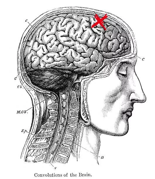 9 Day Headache (Tension? Withdrawal? Or something else?)