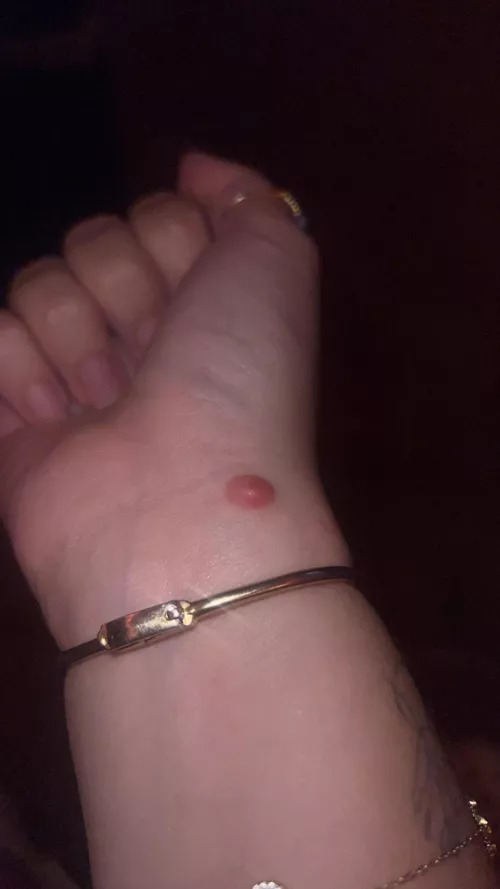 Bump on wrist that I’ve had for a few months now…dermatology appointment next week but want to see what I should be prepared for