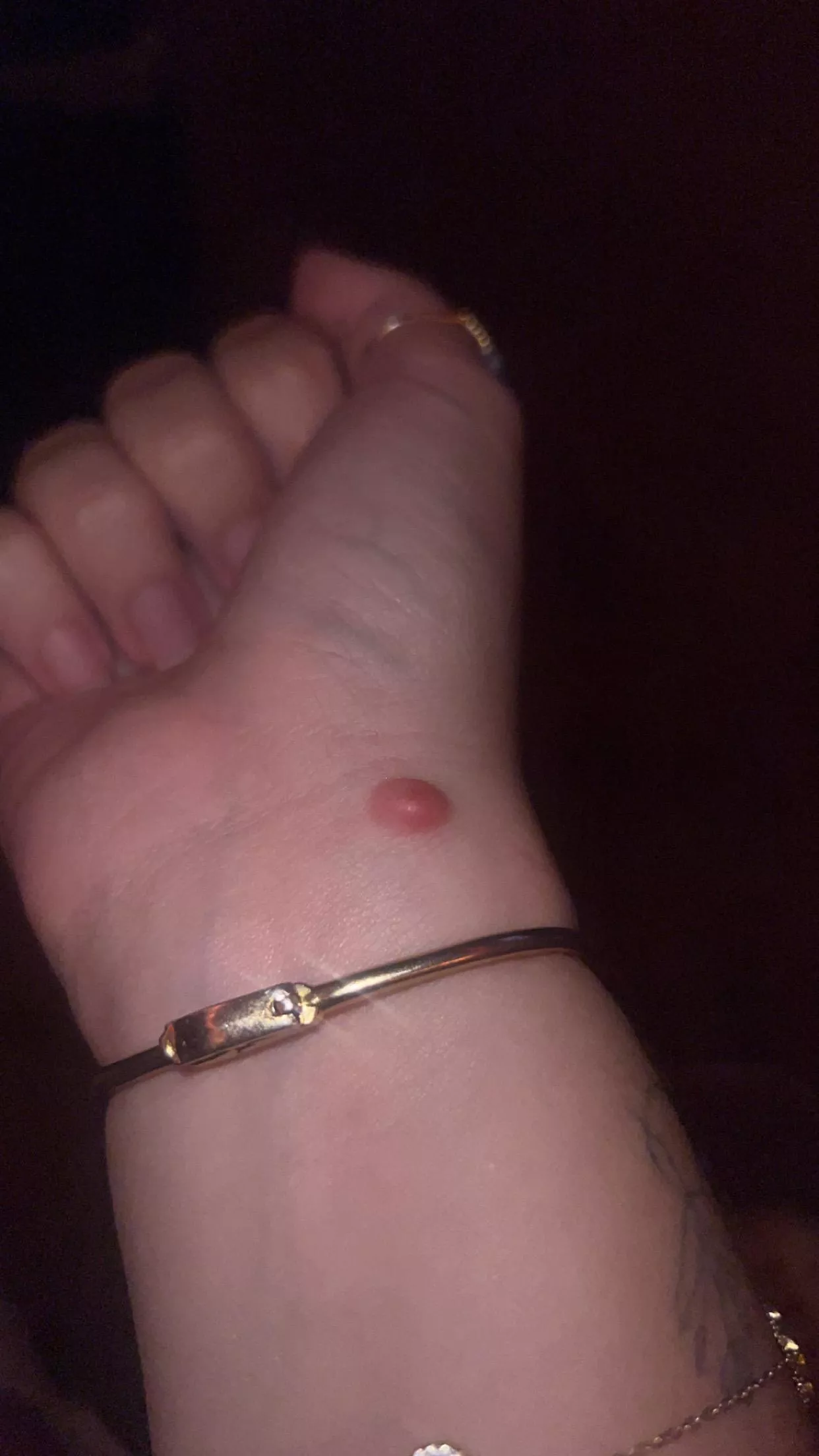 Bump on wrist that I’ve had for a few months now…dermatology appointment next week but want to see what I should be prepared for