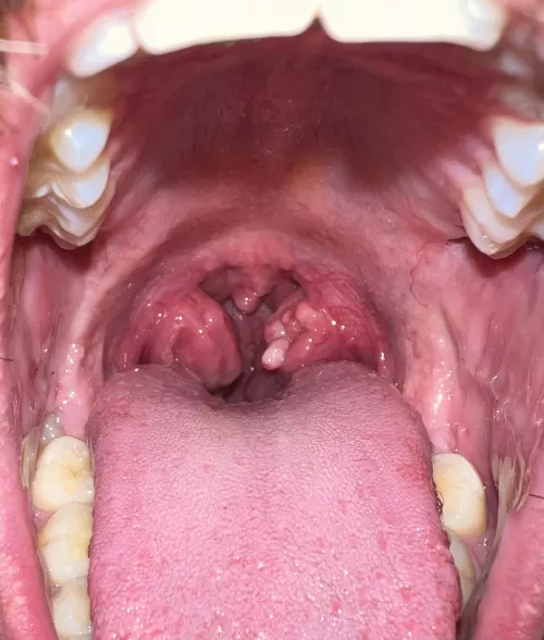 Fleshy bumps appeared in left Tonsil