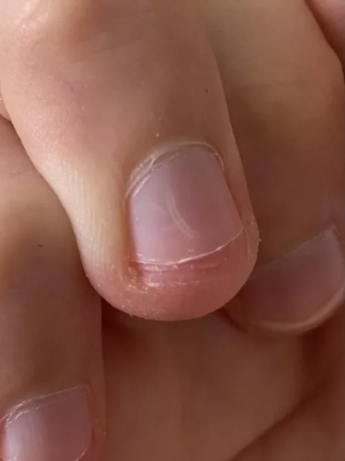 I don’t know if I have something under my nail or have just damaged it somehow. Does anyone know what this is?
