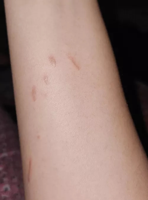 I got burned with hot sunflower cooking oil, will this leave a scar