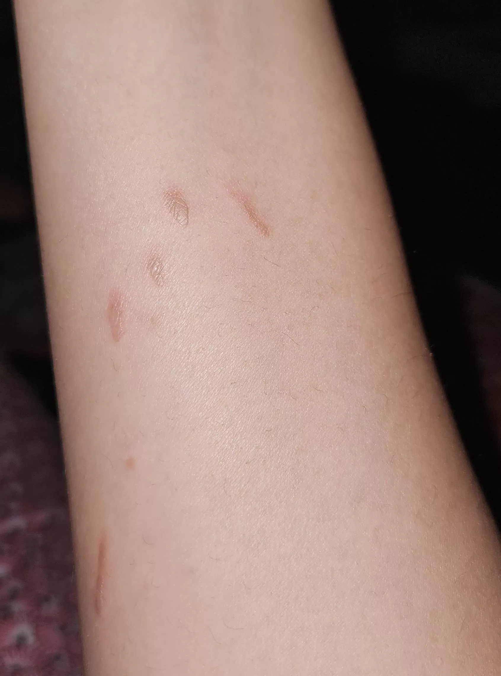 I got burned with hot sunflower cooking oil, will this leave a scar