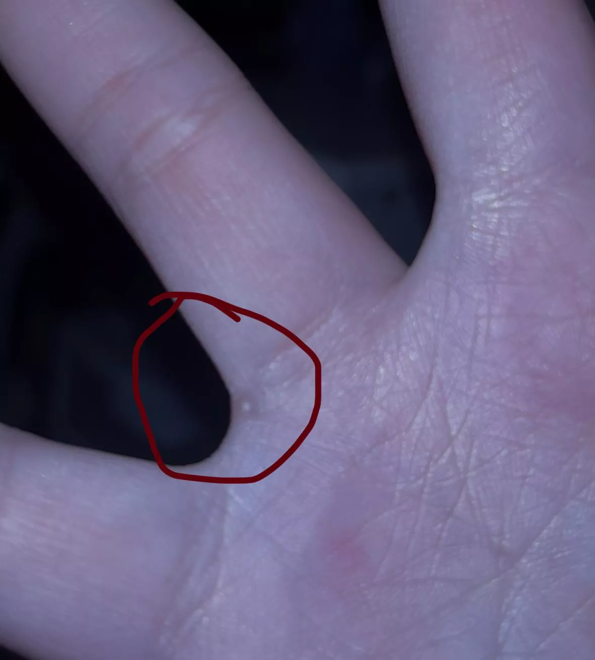 I’ve had this bump on my finger webbing between my ring and middle finger for a few years now. What is it?