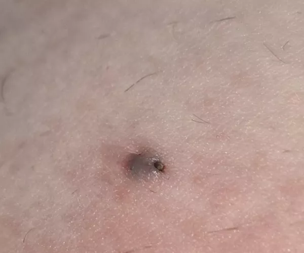 On inner thigh, any idea what this bump is?