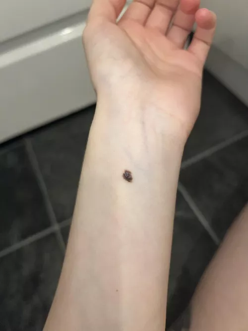 Should I be worried about this mole? 