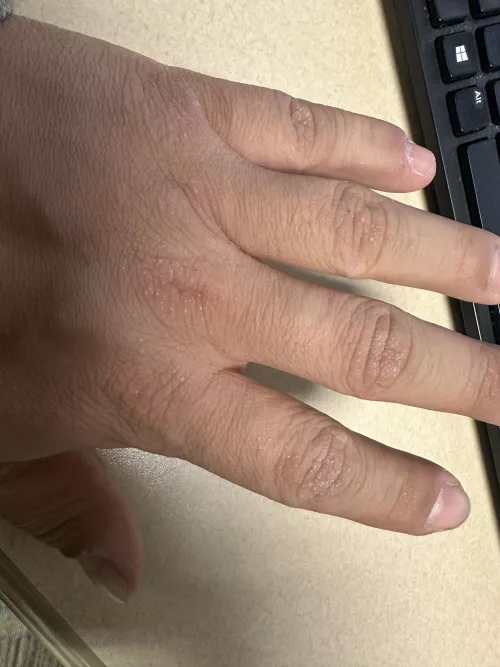 What’s going on with the skin on my hands?