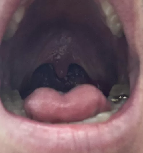 What’s the white on the back of my throat